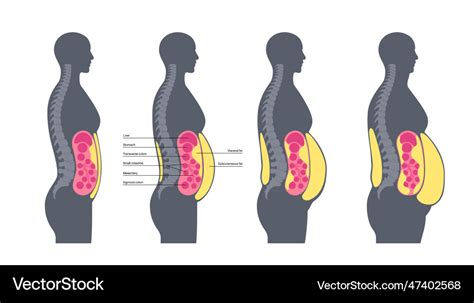 visceral fat lv|visceral fat before and after.